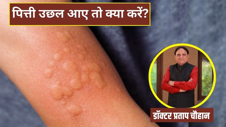 शरीर में पित्ती उछल आए तो क्या करना चाहिए?