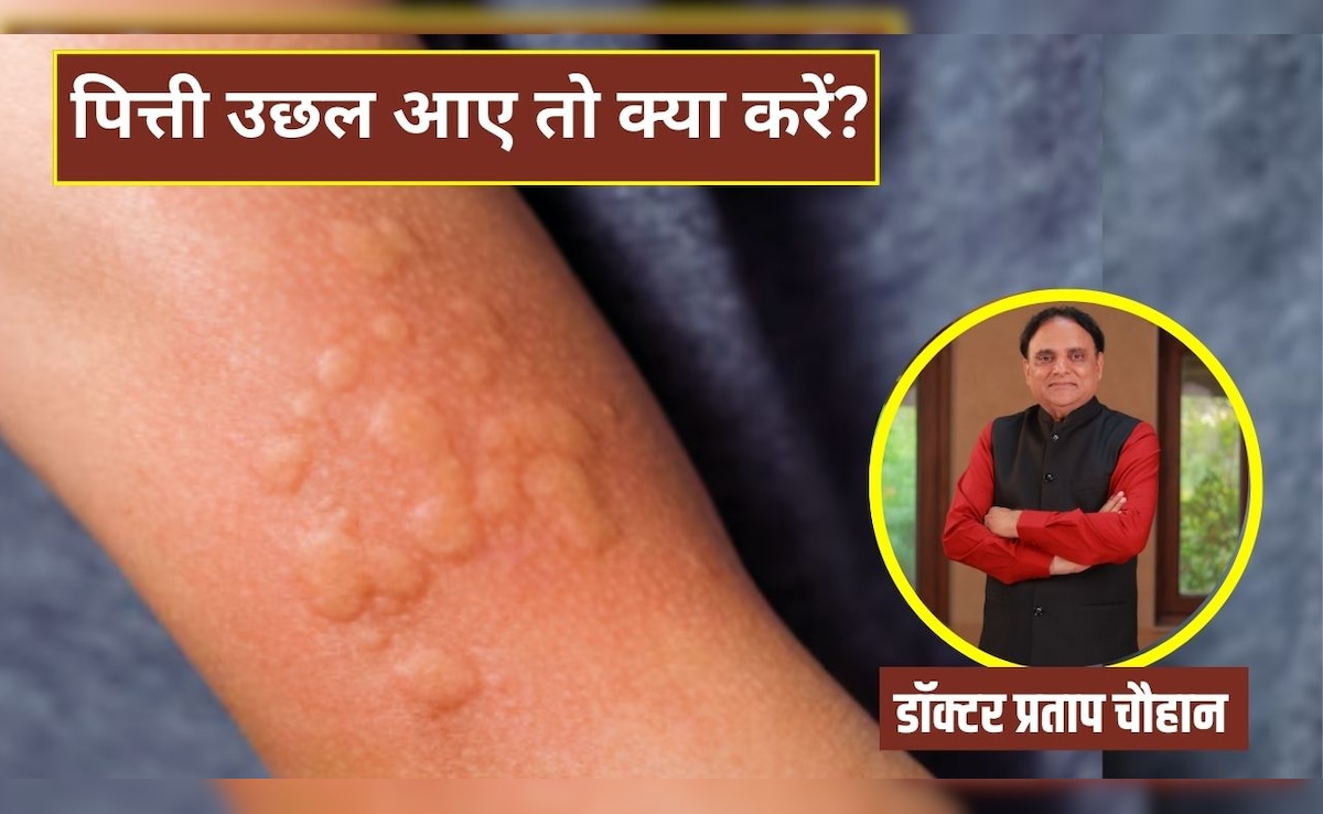 शरीर में पित्ती उछल आए तो क्या करना चाहिए?