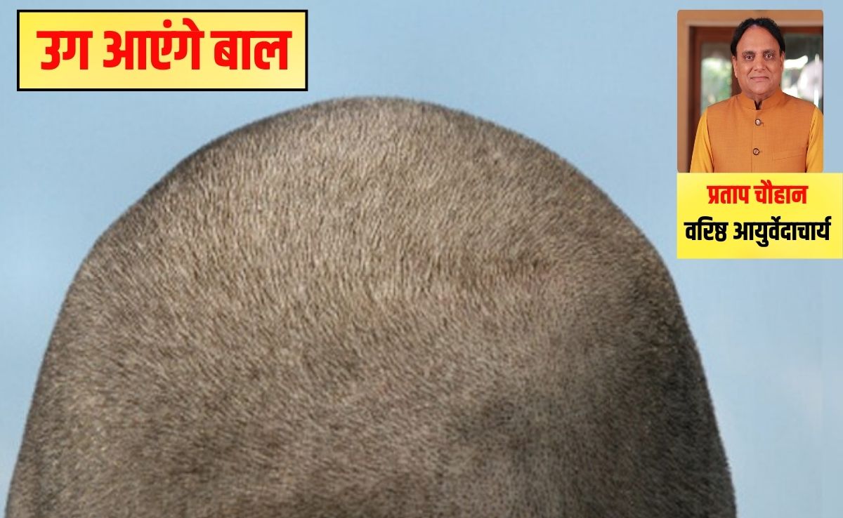 'जहां चाहते हैं बाल उगाना, बस वहीं लगाना', आयुर्वेद‍िक डॉक्‍टर की कड़ी चेतावनी, घर पर सिर्फ 2 मिनट में हो जाएगा तैयार