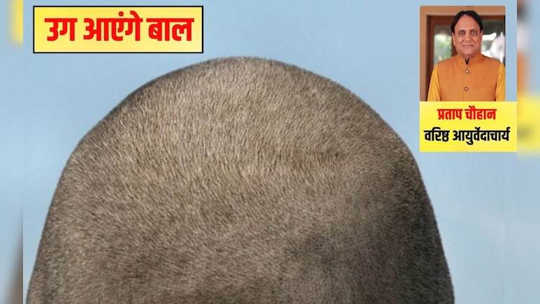 'जहां चाहते हैं बाल उगाना, बस वहीं लगाना', आयुर्वेद‍िक डॉक्‍टर की कड़ी चेतावनी, घर पर सिर्फ 2 मिनट में हो जाएगा तैयार