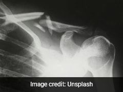 Researchers Develop Modified Glue Gun That Can Repair Complex Bone Fractures