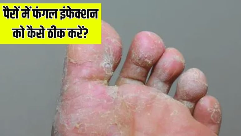 पैरों में फंगल इंफेक्शन हो जाए तो क्या करें? डॉक्टर ने बताया Athlete's Foot से छुटकारा पाने का तरीका