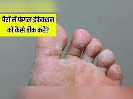 पैरों में फंगल इंफेक्शन हो जाए तो क्या करें? डॉक्टर ने बताया Athlete's Foot से छुटकारा पाने का तरीका पैरों में फंगल इंफेक्शन हो जाए तो क्या करें? डॉक्टर ने बताया Athlete's Foot से छुटकारा पाने का तरीका