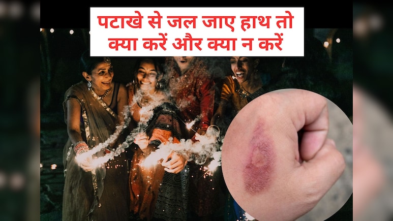Diwali 2025: दीवाली में पटाखे छुड़ाते समय जल जाए हाथ तो तुरंत करें ये काम, नहीं पड़ेंगे फफोले और निशान Diwali 2025: दीवाली में पटाखे छुड़ाते समय जल जाए हाथ तो तुरंत करें ये काम, नहीं पड़ेंगे फफोले और निशान