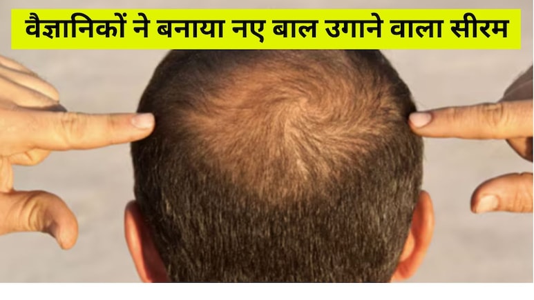 वैज्ञानिकों का दावा, सिर्फ 20 दिन में गंजी खोपड़ी पर उगेंगे नए बाल, हेयर ग्रोथ के लिए बनाया चमत्कारी सीरम वैज्ञानिकों का दावा, सिर्फ 20 दिन में गंजी खोपड़ी पर उगेंगे नए बाल, हेयर ग्रोथ के लिए बनाया चमत्कारी सीरम
