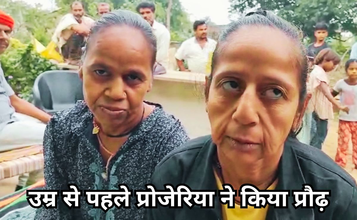 दुनिया भर में हैं इस दुर्लभ बीमारी के 500 मरीज, MP में भी मिले चार, जिन्हें जवानी में आ रहा बुढ़ापा!