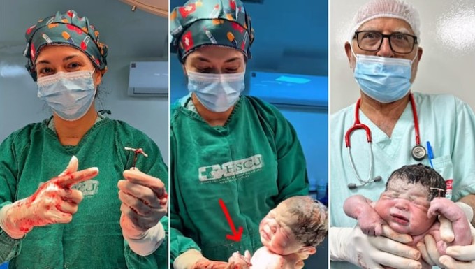 गर्भनिरोधक कॉइल भी न रोक सका जन्म, पैदा होते ही हाथ में Contraceptive Coil पकड़े दिखा बच्चा, डॉक्टर भी हैरान