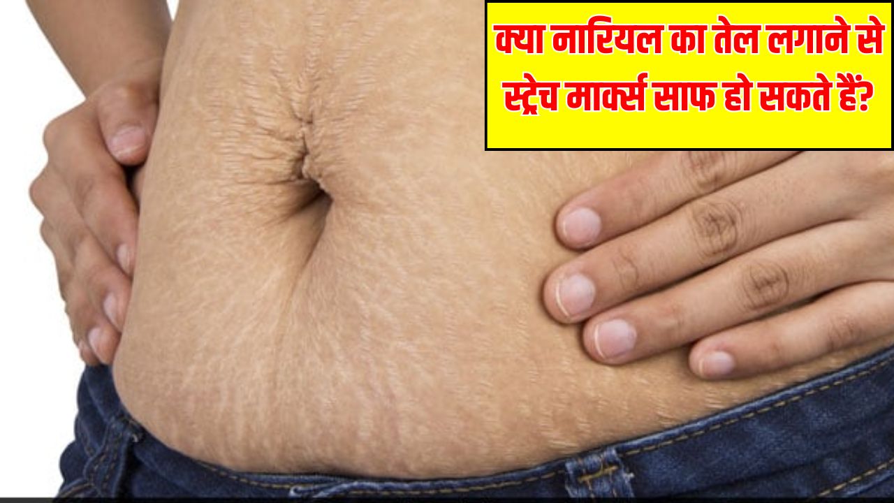 क्या नारियल का तेल स्ट्रेच मार्क्स को हटा सकता है? डर्माटोलॉजिस्ट से जानें स्किन पर नारियल का तेल लगाने से क्या होता है