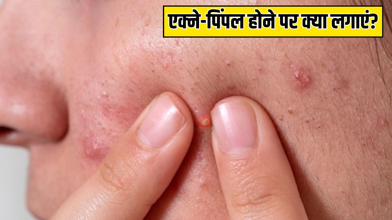 एक्ने-पिंपल होने पर कौन सा सीरम लगाना चाहिए? डर्माटोलॉजिस्ट ने बताया क्या लगाने से एकदम क्लियर हो जाएगी स्किन