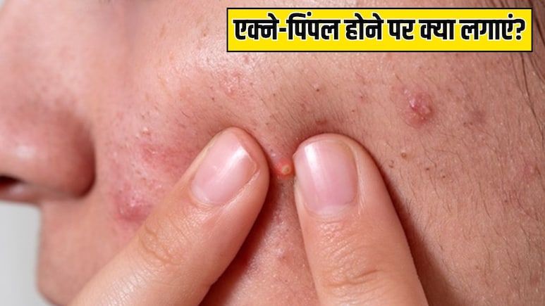 एक्ने-पिंपल होने पर कौन सा सीरम लगाना चाहिए? डर्माटोलॉजिस्ट ने बताया क्या लगाने से एकदम क्लियर हो जाएगी स्किन