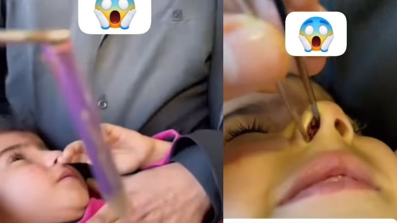 VIDEO: खेल-खेल में बच्ची ने नाक में घुसा ली पेंसिल, डॉक्टर ने इस तरह निकाला बाहर VIDEO: खेल-खेल में बच्ची ने नाक में घुसा ली पेंसिल, डॉक्टर ने इस तरह निकाला बाहर