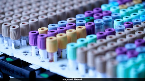 AIIMS Introduces In-House, Free Drug-Level Tests For Epilepsy Patients