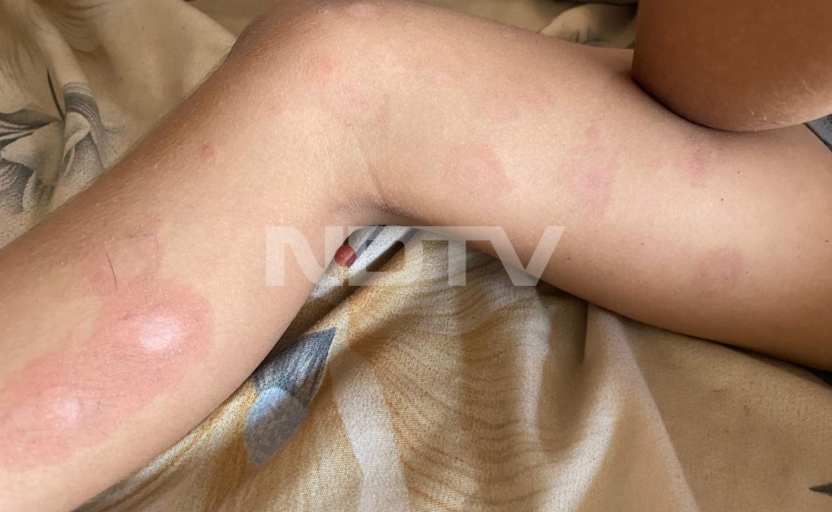 Esraas son developed rashes across his body due to contaminated water in Gaza. Esraas son developed rashes across his body due to contaminated water in Gaza.