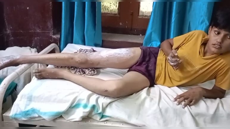 Rajasthan News: जेब और बैग में रखा पोटास फटा, दीपावली से पहले बर्डोद में मचा हड़कंप