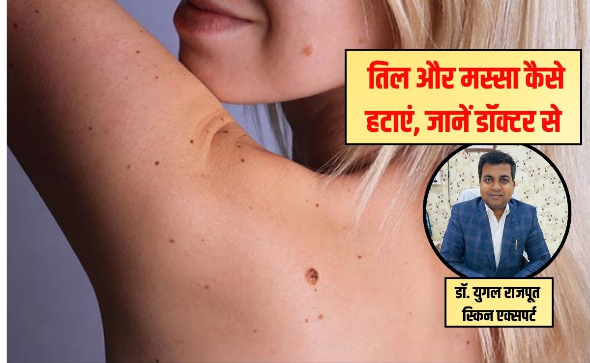 Tips and Tricks: त्‍वचा पर तिल को लेकर हैं परेशान? स्‍क‍िन एक्‍सपर्ट से जान‍िए आसान घरेलू नुस्खे, बिना खर्च हो जाएगी ग्लोइंग स्किन