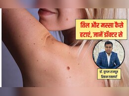 Tips and Tricks: त्‍वचा पर तिल को लेकर हैं परेशान? स्‍क‍िन एक्‍सपर्ट से जान‍िए आसान घरेलू नुस्खे, बिना खर्च हो जाएगी ग्लोइंग स्किन