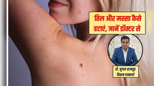 Tips and Tricks: त्‍वचा पर तिल को लेकर हैं परेशान? स्‍क‍िन एक्‍सपर्ट से जान‍िए आसान घरेलू नुस्खे, बिना खर्च हो जाएगी ग्लोइंग स्किन