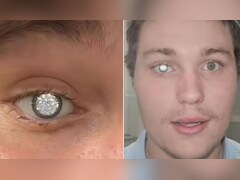 VIRAL: दाईं आंख की रोशनी हुई कम, तो शख्स ने आंख में जड़वा लिया 2 कैरेट का हीरा