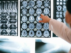 Men&#039;s Brains Shrink Faster Than Women&#039;s With Age, New Study Shows