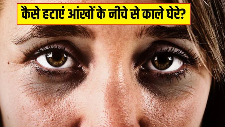 चाय पत्ती, कॉफी या खीरा, किससे जल्दी साफ हो सकते हैं Dark Circles? स्किन की डॉक्टर से जान लें