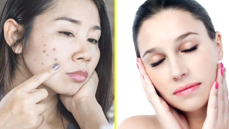 पिंपल्स चले गए लेकिन रह गए दाग-धब्बे? अपनाएं ये 5 सरल घरेलू उपाय, मुंहासे भी होंगे दूर