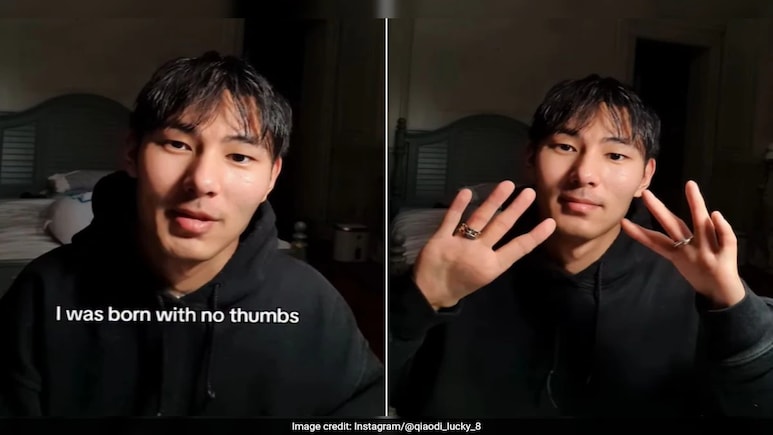 Video: Chinese Man, Born Without Thumbs, Goes Viral For Creativity And Humour Video: Chinese Man, Born Without Thumbs, Goes Viral For Creativity And Humour