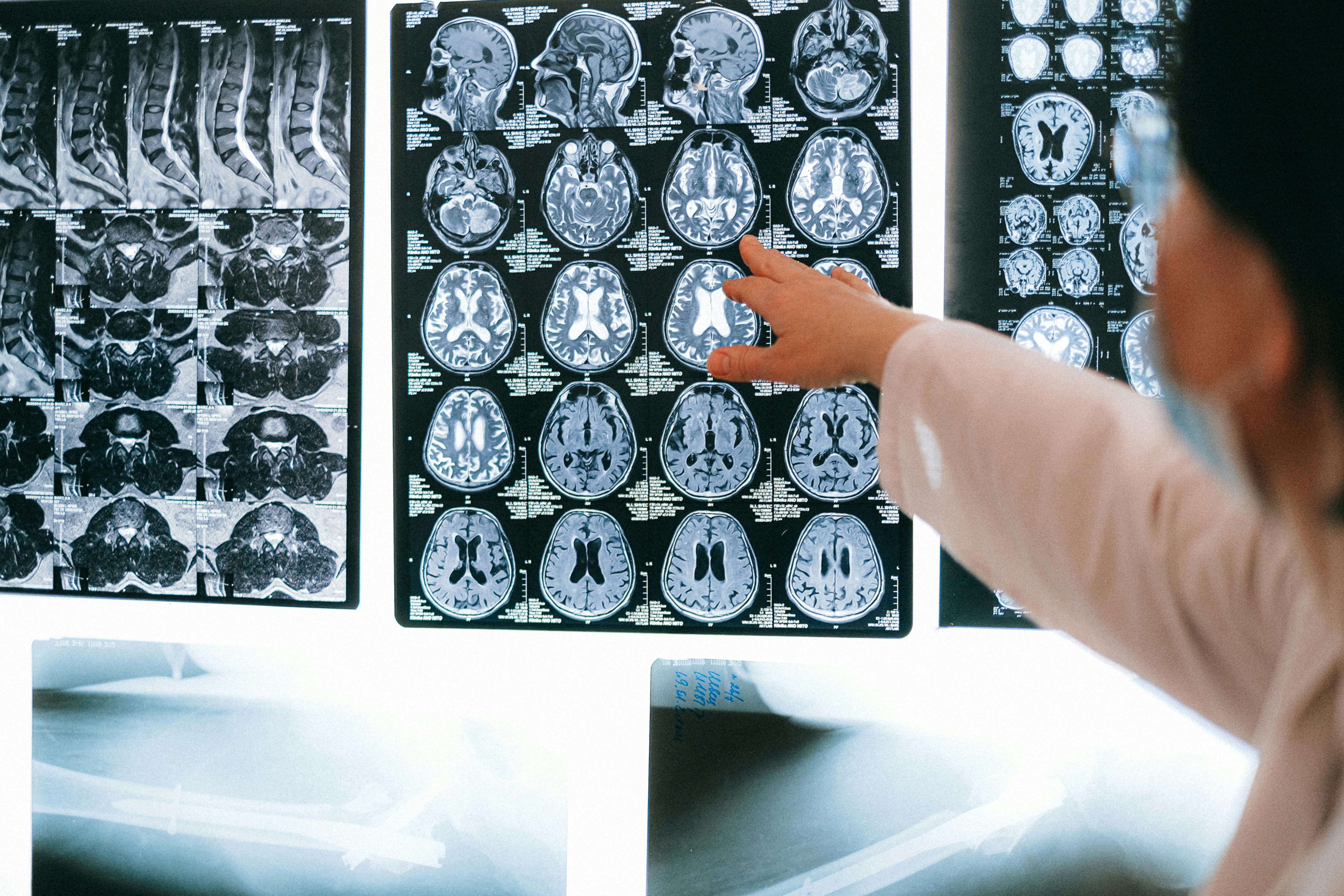 Neurological disorders begin long before visible disability appears