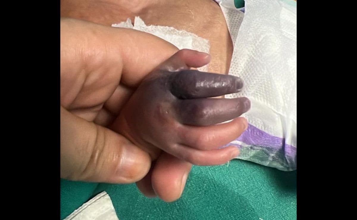 Newborn Set To Lose Hand After Greater Noida Hospital Gives Her Wrong Injection