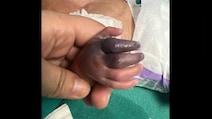 Newborn Set To Lose Hand After Greater Noida Hospital Gives Her Wrong Injection