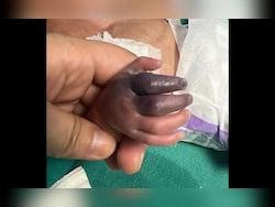 Newborn Set To Lose Hand After Greater Noida Hospital Gives Her Wrong Injection