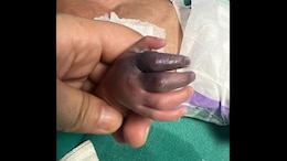 Newborn Set To Lose Hand After Greater Noida Hospital Gives Her Wrong Injection