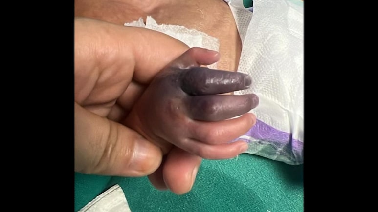 Newborn Set To Lose Hand After Greater Noida Hospital Gives Her Wrong Injection Newborn Set To Lose Hand After Greater Noida Hospital Gives Her Wrong Injection