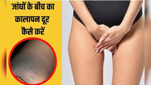 प्राइवेट पार्ट के कालेपन को कैसे साफ करें? प्राइवेट पार्ट पर क्या लगाना चाहिए डॉक्‍टर से जान‍िए