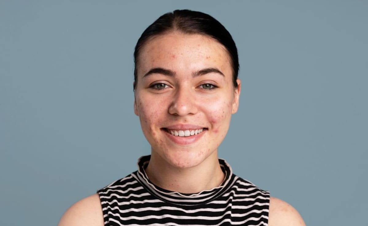 A woman with breakouts on her face. Photo: Pixabay A woman with breakouts on her face. Photo: Pixabay