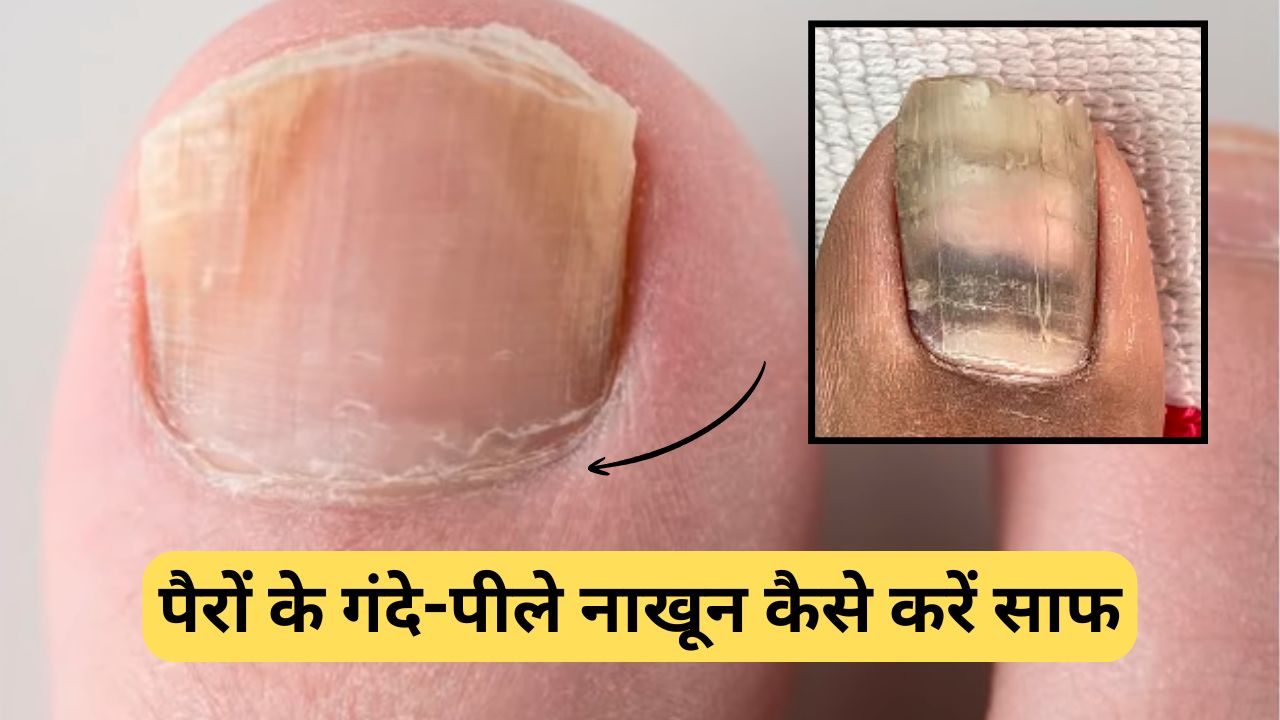पैरों के गंदे-पीले नाखूनों को कैसे करें साफ? जानिए आसानी से सफाई करने की टिप्स, आ जाएगी चमक