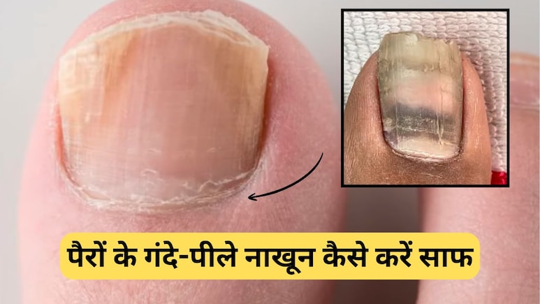 पैरों के गंदे-पीले नाखूनों को कैसे करें साफ? जानिए आसानी से सफाई करने की टिप्स, आ जाएगी चमक पैरों के गंदे-पीले नाखूनों को कैसे करें साफ? जानिए आसानी से सफाई करने की टिप्स, आ जाएगी चमक