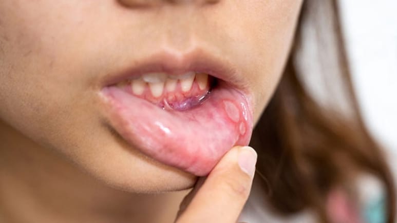 Mouth Ulcers Home Remedies: मुंह के छालों ने खाना कर दिया है मुश्किल? अपनाएं ये घरेलू नुस्खें, जल्द दिखने लगेगा असर! Mouth Ulcers Home Remedies: मुंह के छालों ने खाना कर दिया है मुश्किल? अपनाएं ये घरेलू नुस्खें, जल्द दिखने लगेगा असर!