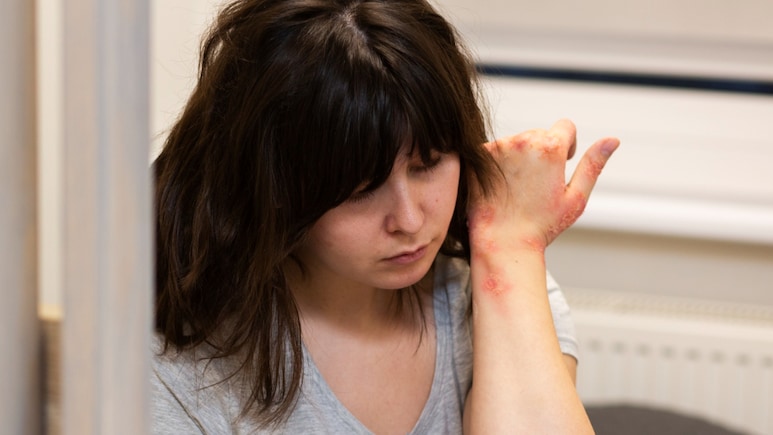 Psoriasis Isn't Just Skin Deep, It Impacts Mental Health Too: Survivor Explains