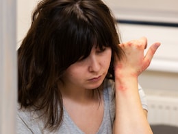 Psoriasis Isn't Just Skin Deep, It Impacts Mental Health Too: Survivor Explains Psoriasis Isn't Just Skin Deep, It Impacts Mental Health Too: Survivor Explains