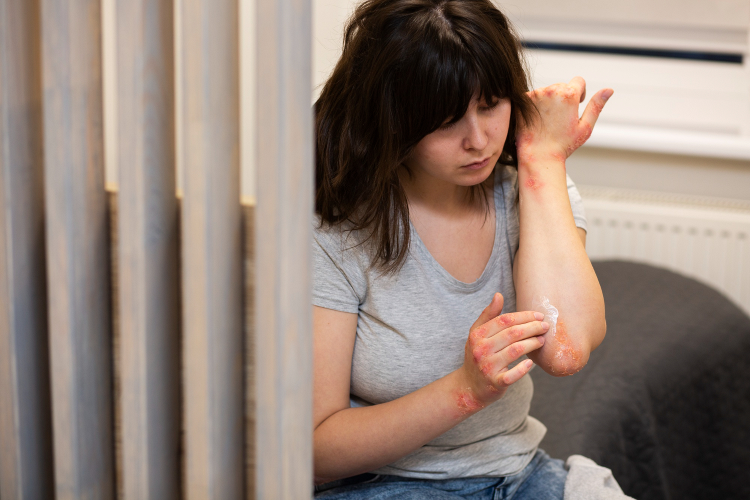 Psoriasis Isn't Just Skin Deep, It Impacts Mental Health Too: Survivor Explains