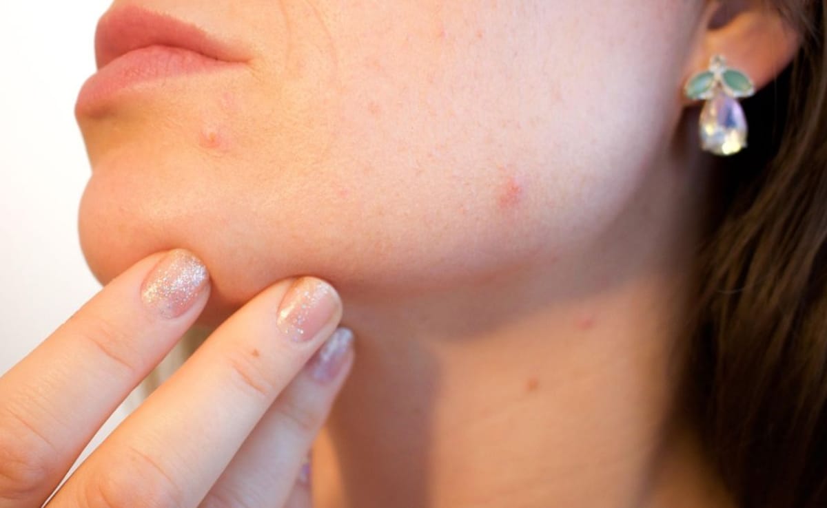 A woman with acne on her face. Photo: Pixabay A woman with acne on her face. Photo: Pixabay