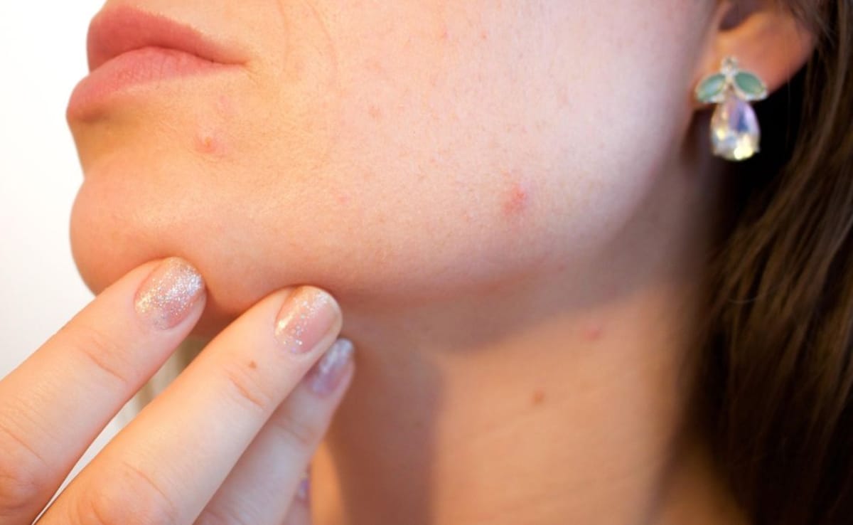 Can Everyday Foods Trigger Acne? Dermatologist Breaks Down Truth Behind Common Myths