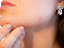 Can Everyday Foods Trigger Acne? Dermatologist Breaks Down Truth Behind Common Myths