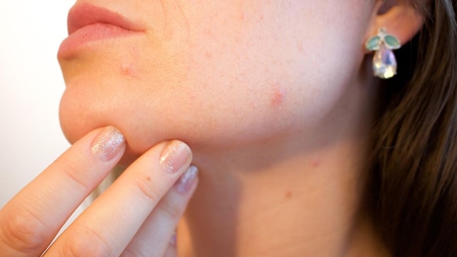 Beyond The Surface: Why Your Stubborn Breakouts Might Be A Cry For Help From Your Liver