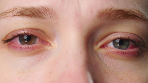 दिल्ली की जहरीली हवा से आंख की 50% तक बढ़ी समस्या