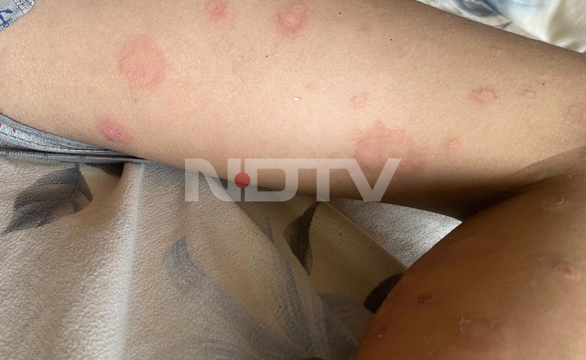 Small bumps spread across his arms, legs, and back. Small bumps spread across his arms, legs, and back.