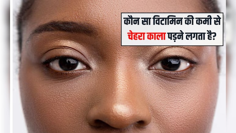 कौन सा विटामिन की कमी से चेहरा काला पड़ने लगता है? चेहरे पर चमक क्या खाने से आती है, जानिए यहां पर कौन सा विटामिन की कमी से चेहरा काला पड़ने लगता है? चेहरे पर चमक क्या खाने से आती है, जानिए यहां पर