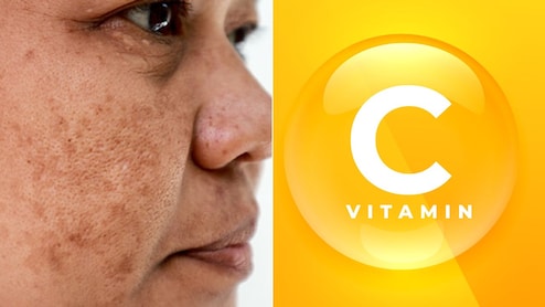 झाइयों के लिए Vitamin C के कैप्सूल खाएं या सीरम लगाएं? स्किन के डॉक्टर से जान लें