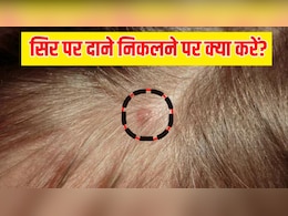 सिर पर छोटे-छोटे दाने क्यों निकलते हैं? हेयर एक्सपर्ट से जानें कैसे ठीक करें ये दिक्कत सिर पर छोटे-छोटे दाने क्यों निकलते हैं? हेयर एक्सपर्ट से जानें कैसे ठीक करें ये दिक्कत
