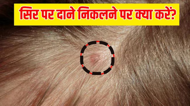 सिर पर छोटे-छोटे दाने क्यों निकलते हैं? हेयर एक्सपर्ट से जानें कैसे ठीक करें ये दिक्कत सिर पर छोटे-छोटे दाने क्यों निकलते हैं? हेयर एक्सपर्ट से जानें कैसे ठीक करें ये दिक्कत